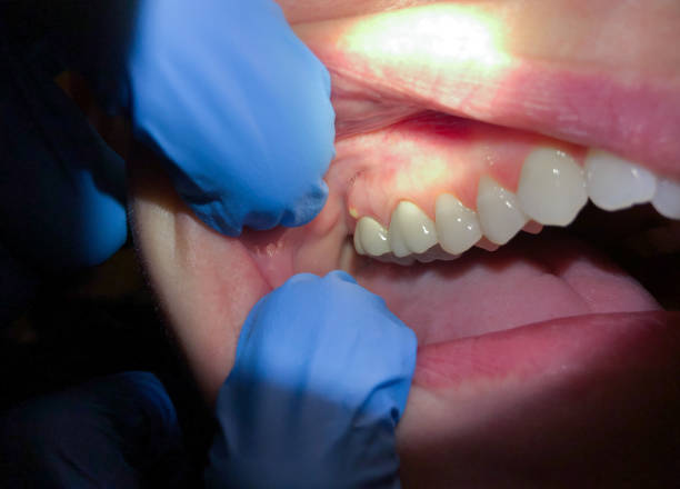Best Emergency Dentist for Lost Fillings or Crowns in Clarks Green, PA